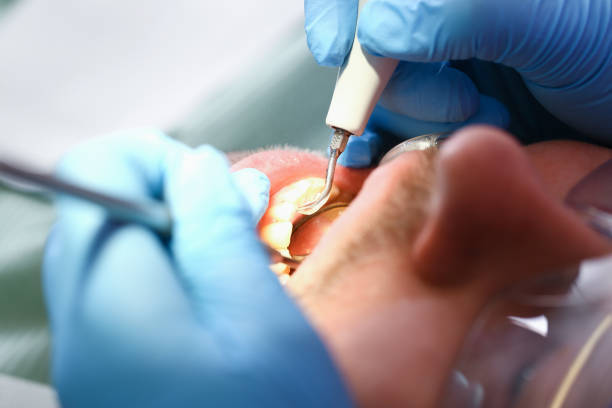 Best Emergency Treatment for Dental Infections or Abscesses in Cincinnati, OH